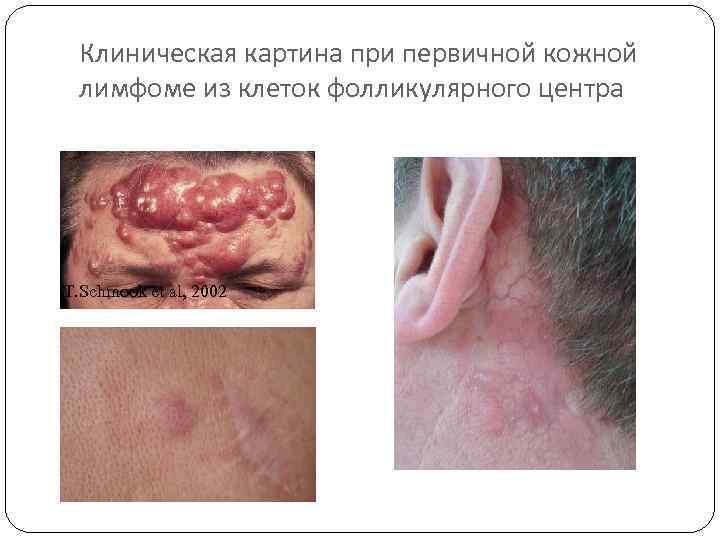 Клиническая картина при первичной кожной лимфоме из клеток фолликулярного центра T. Schmook et al,