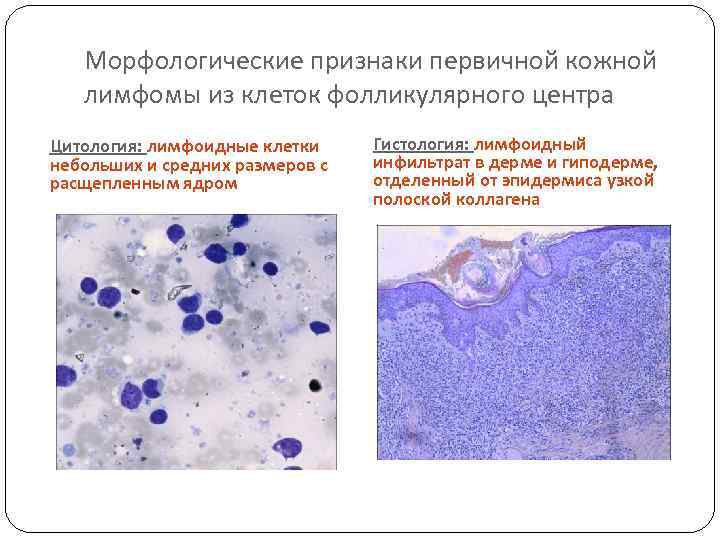 Морфологические признаки первичной кожной лимфомы из клеток фолликулярного центра Цитология: лимфоидные клетки небольших и