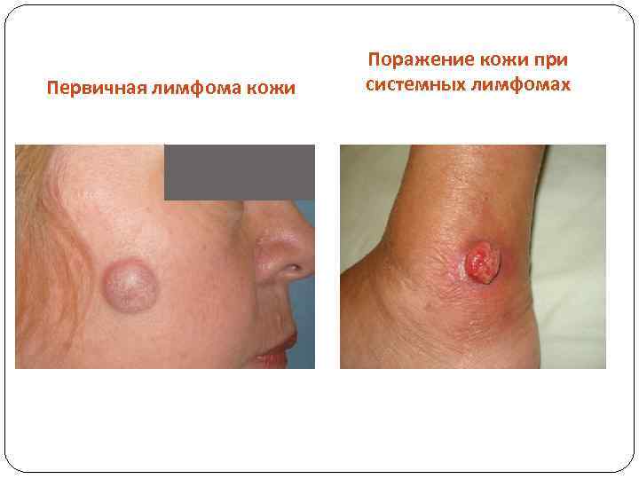 Первичная лимфома кожи Поражение кожи при системных лимфомах 