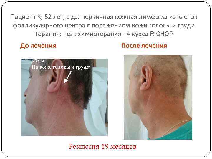 Пациент К, 52 лет, с дз: первичная кожная лимфома из клеток фолликулярного центра с