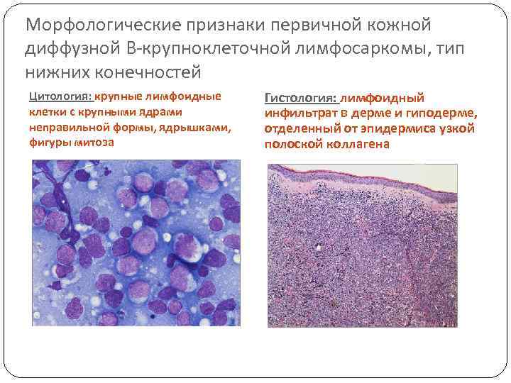 Морфологические признаки первичной кожной диффузной В-крупноклеточной лимфосаркомы, тип нижних конечностей Цитология: крупные лимфоидные клетки