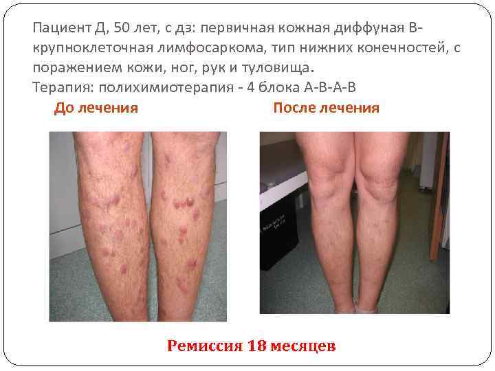 Пациент Д, 50 лет, с дз: первичная кожная диффуная Вкрупноклеточная лимфосаркома, тип нижних конечностей,