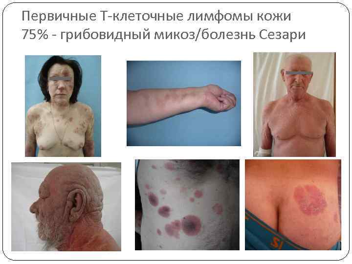 Первичные Т-клеточные лимфомы кожи 75% - грибовидный микоз/болезнь Сезари 