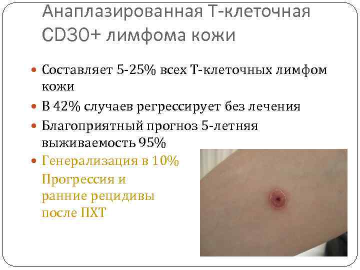 Анаплазированная Т-клеточная CD 30+ лимфома кожи Составляет 5 -25% всех Т-клеточных лимфом кожи В
