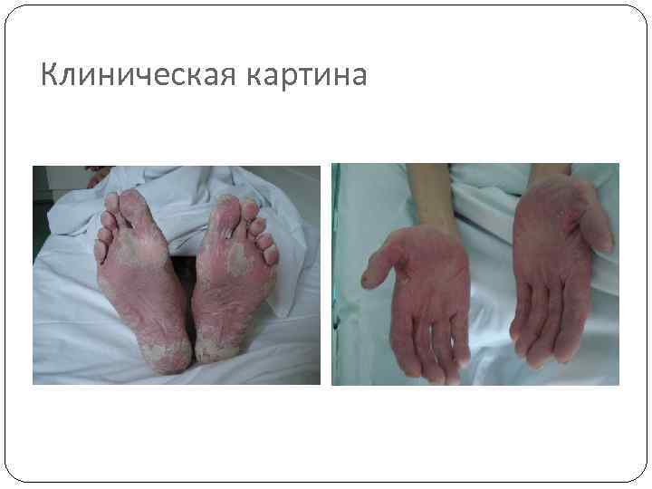 Клиническая картина 