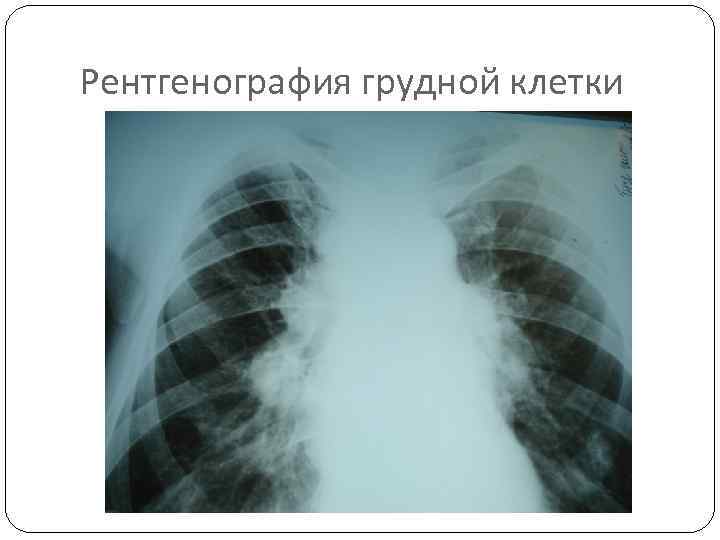 Рентгенография грудной клетки 