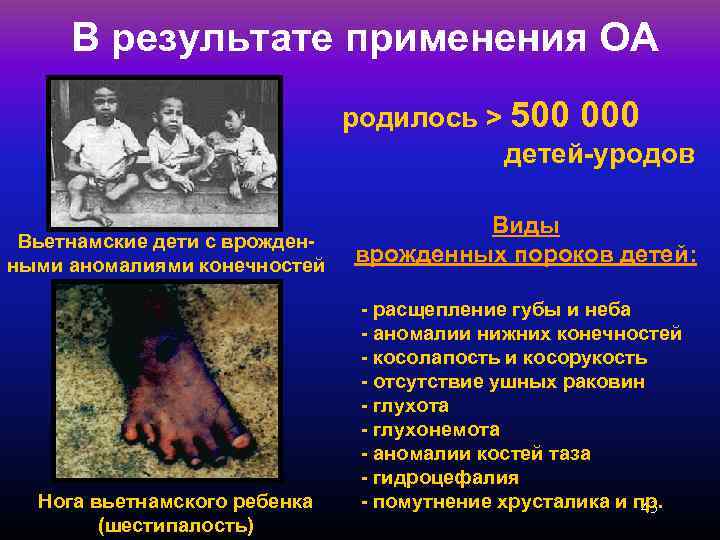 В результате применения ОА родилось > 500 000 детей-уродов Вьетнамские дети с врожденными аномалиями
