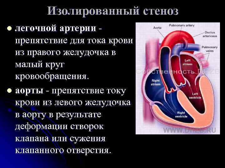 Изолированный стеноз легочной артерии - препятствие для тока крови из правого желудочка в малый