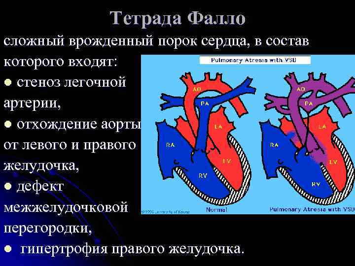 Тетрада Фалло сложный врожденный порок сердца, в состав которого входят: l стеноз легочной артерии,