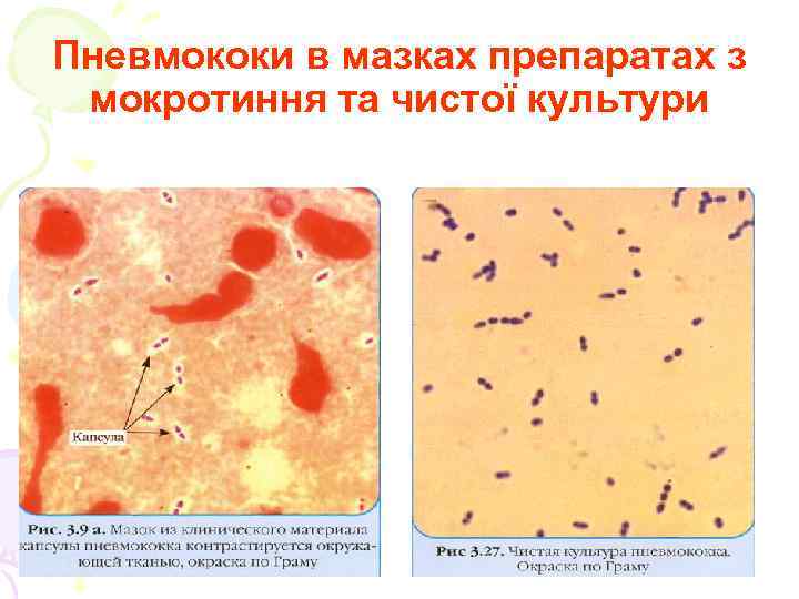 Пневмококи в мазках препаратах з мокротиння та чистої культури 
