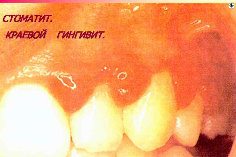 СТОМАТИТ. КРАЕВОЙ ГИНГИВИТ. 