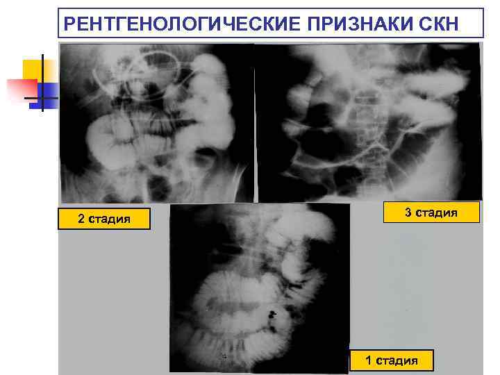 РЕНТГЕНОЛОГИЧЕСКИЕ ПРИЗНАКИ СКН 2 стадия 3 стадия 1 стадия 