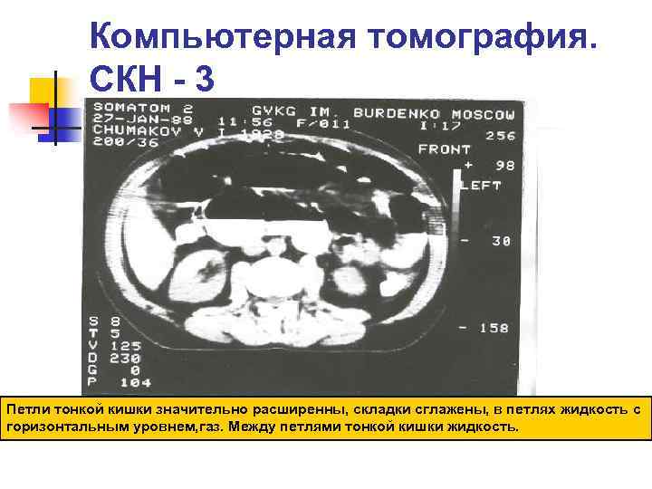 Компьютерная томография. СКН - 3 Петли тонкой кишки значительно расширенны, складки сглажены, в петлях