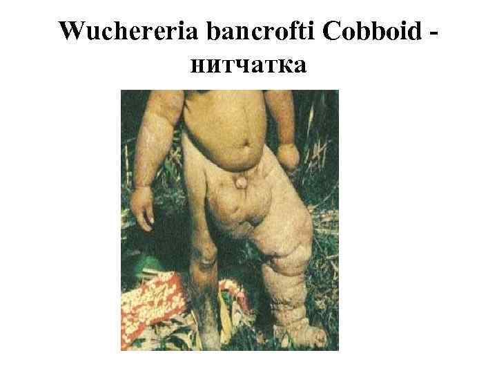 Wuchereria bancrofti Cobboid нитчатка 