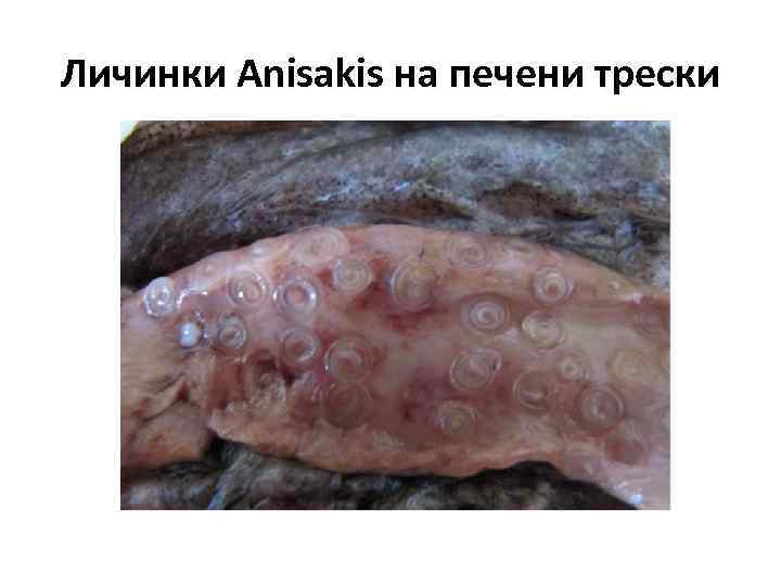 Личинки Anisakis на печени трески 