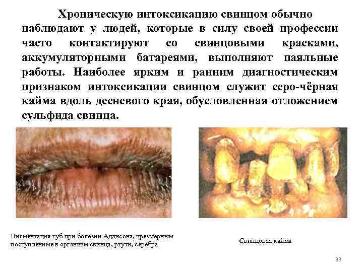 Хроническую интоксикацию свинцом обычно наблюдают у людей, которые в силу своей профессии часто контактируют