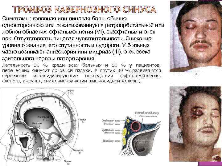 Симптомы: головная или лицевая боль, обычно одностороннюю или локализованную в ретроорбитальной или лобной областях,