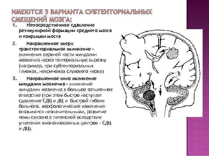 1. Непосредственное сдавление ретикулярной формации среднего мозга и покрышки моста 2. Направленное вверх транстенториальное