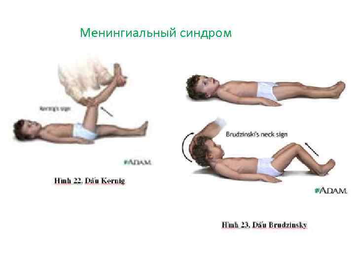 Менингиальный синдром 