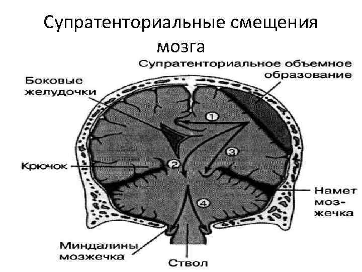 Образование в мозге