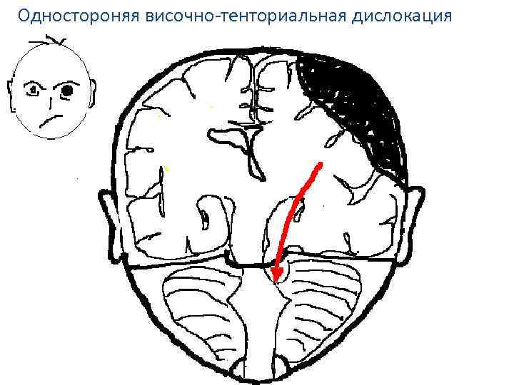 Одностороняя височно-тенториальная дислокация 