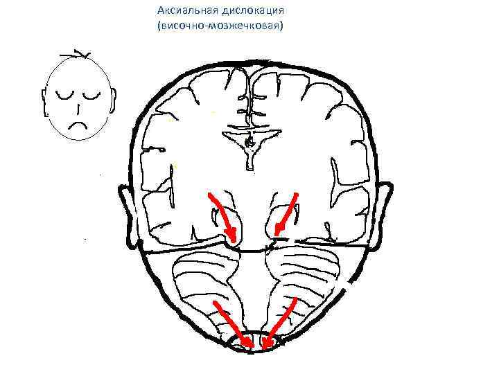 Аксиальная дислокация (височно-мозжечковая) 