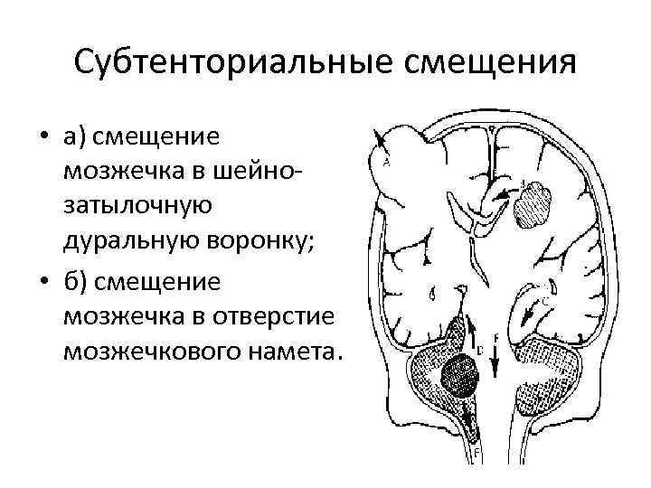 Субтенториальные смещения • а) смещение мозжечка в шейнозатылочную дуральную воронку; • б) смещение мозжечка