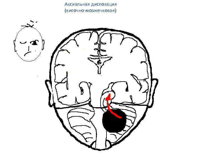 Аксиальная дислокация (височно-мозжечковая) 