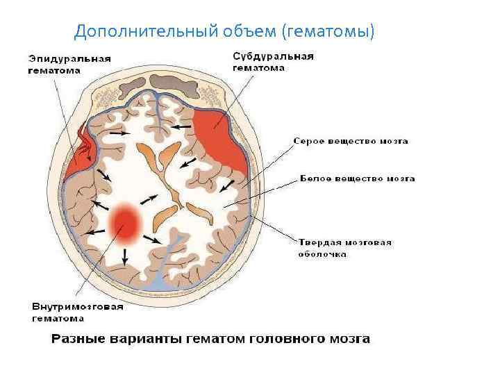 Дополнительный объем (гематомы) 