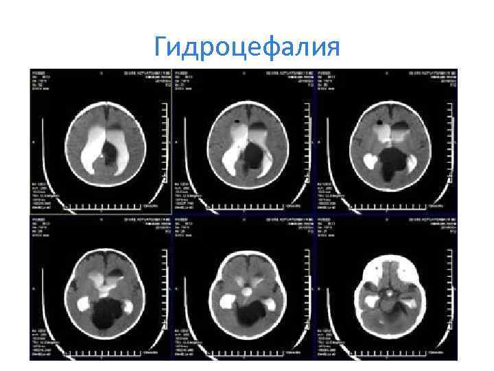 Гидроцефалия 