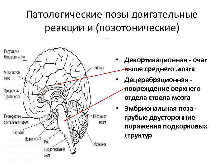 Патологические позы двигательные реакции и (позотонические) • Декортикационная - очаг выше среднего мозга •