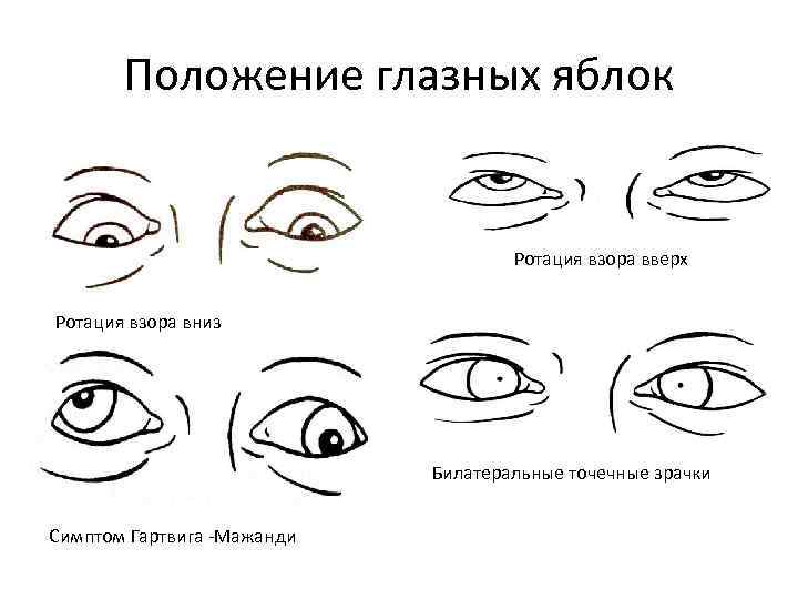 В каком положении находятся. Положение глаз во время сна. Положение глаз человека во сне. Симптом Гертвига-Мажанди. Положение глазного яблока.