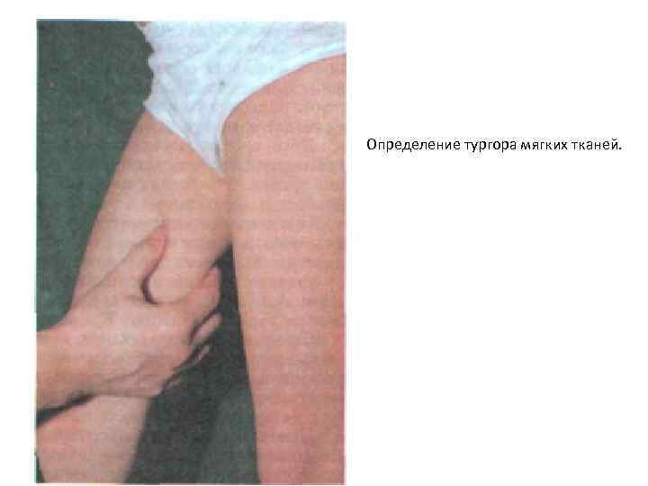 Определение тургора мягких тканей. 