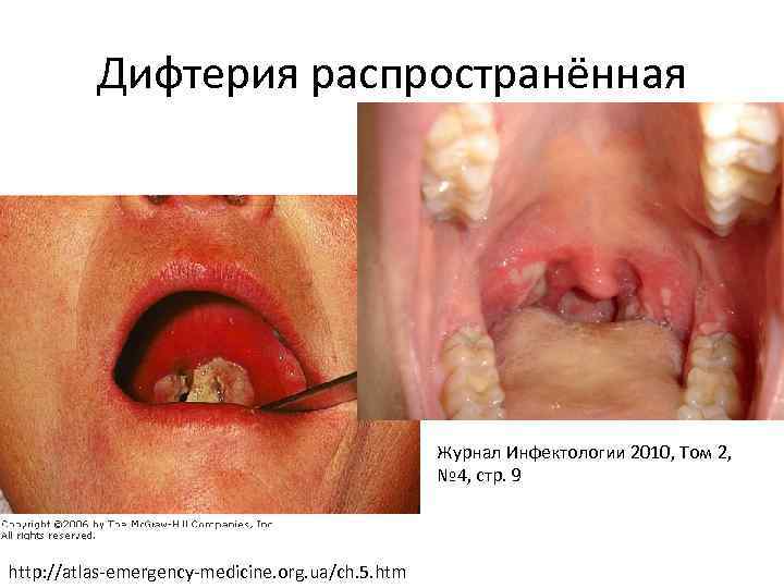 Дифтерия распространённая Журнал Инфектологии 2010, Том 2, № 4, стр. 9 http: //atlas-emergency-medicine. org.