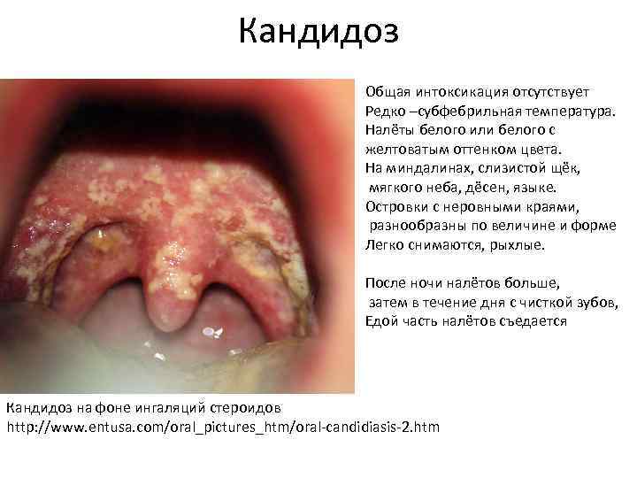 Кандидоз Общая интоксикация отсутствует Редко –субфебрильная температура. Налёты белого или белого с желтоватым оттенком