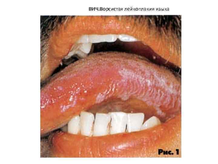 ВИЧ. Ворсистая лейкоплакия языка 