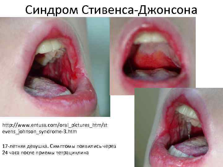 Синдром Стивенса-Джонсона http: //www. entusa. com/oral_pictures_htm/st evens_johnson_syndrome-3. htm 17 -летняя девушка. Симптомы появились через