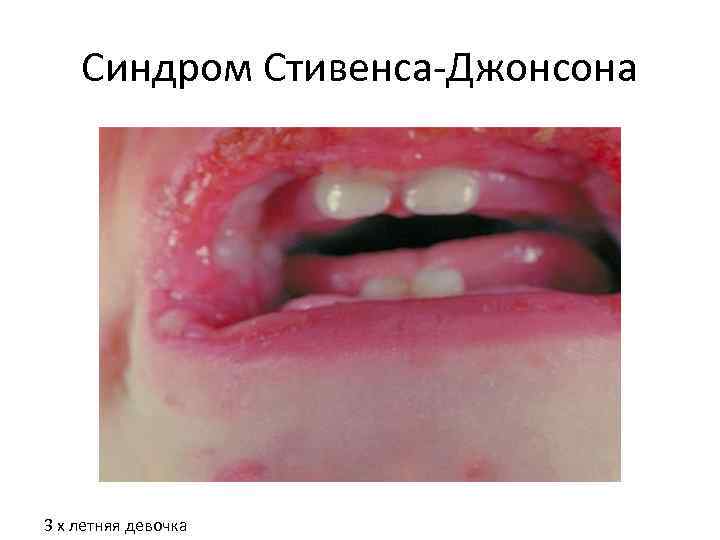 Синдром Стивенса-Джонсона 3 х летняя девочка 