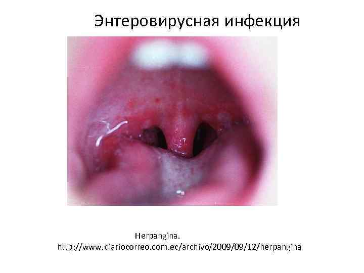 Энтеровирусная инфекция Herpangina. http: //www. diariocorreo. com. ec/archivo/2009/09/12/herpangina 