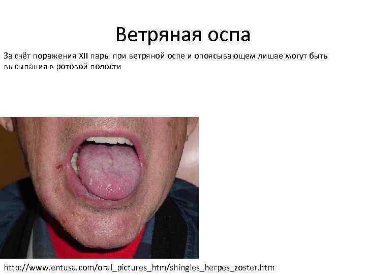Ветряная оспа За счёт поражения XII пары при ветряной оспе и опоясывающем лишае могут