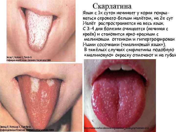 Скарлатина Язык с 1 х суток начинает у корня покрываться серовато-белым налётом, на 2
