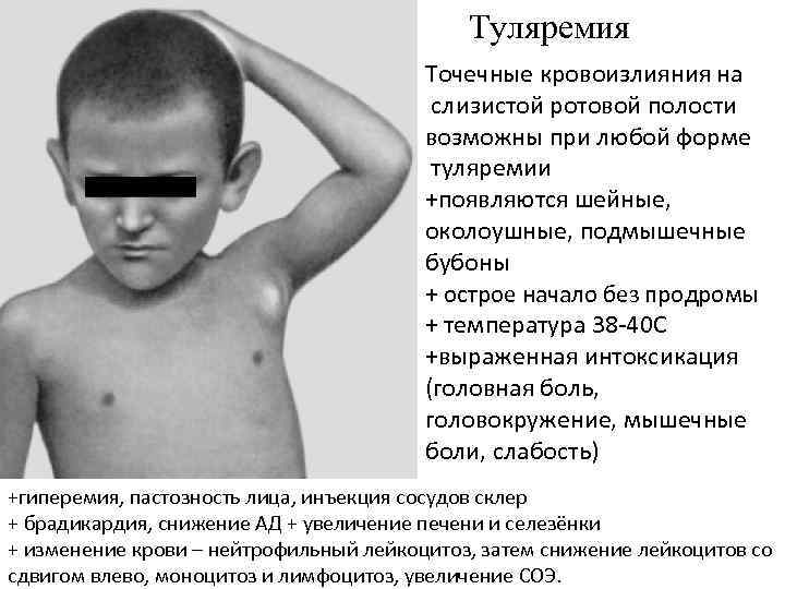 Туляремия Точечные кровоизлияния на слизистой ротовой полости возможны при любой форме туляремии +появляются шейные,