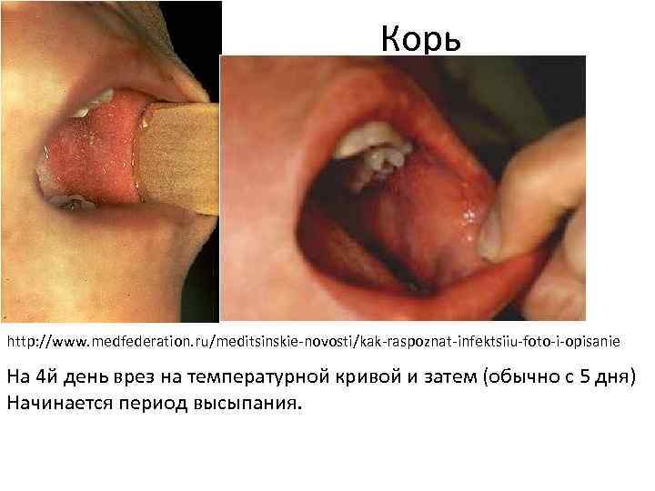 Корь http: //www. medfederation. ru/meditsinskie-novosti/kak-raspoznat-infektsiiu-foto-i-opisanie На 4 й день врез на температурной кривой и