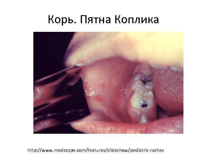 Корь. Пятна Коплика http: //www. medscape. com/features/slideshow/pediatric-rashes 