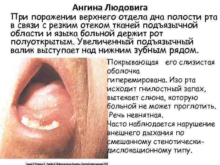 Ангина Людовига При поражении верхнего отдела дна полости рта в связи с резким отеком
