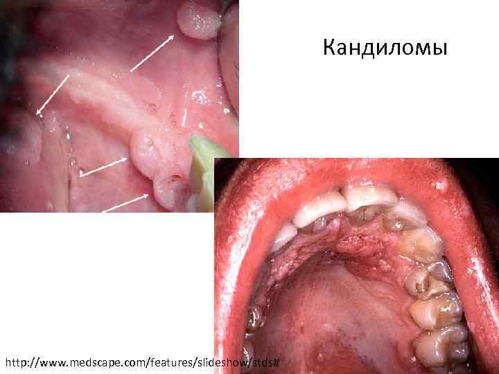 Кандиломы http: //www. medscape. com/features/slideshow/stds# 