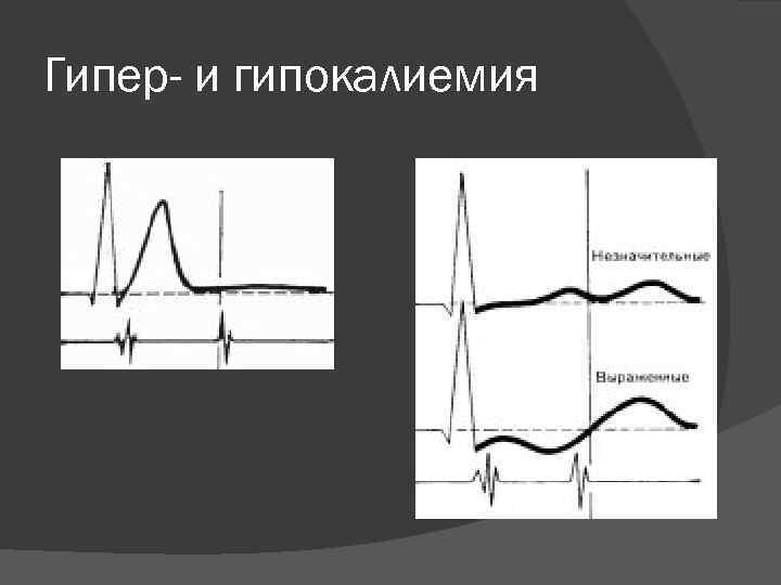 Гипер- и гипокалиемия 