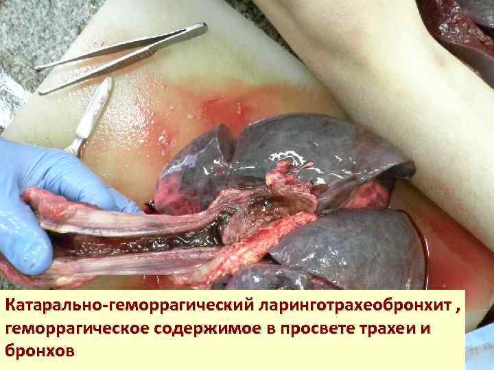 Катарально-геморрагический ларинготрахеобронхит , геморрагическое содержимое в просвете трахеи и бронхов 