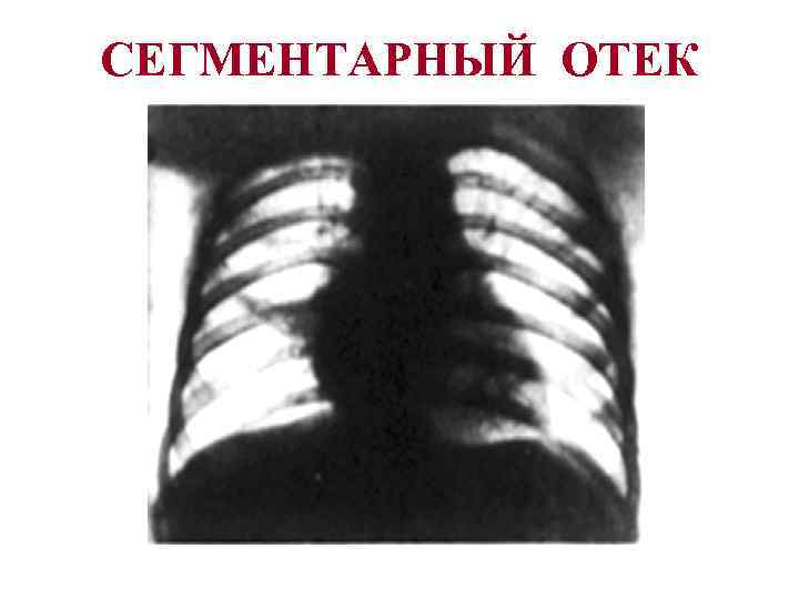 СЕГМЕНТАРНЫЙ ОТЕК 