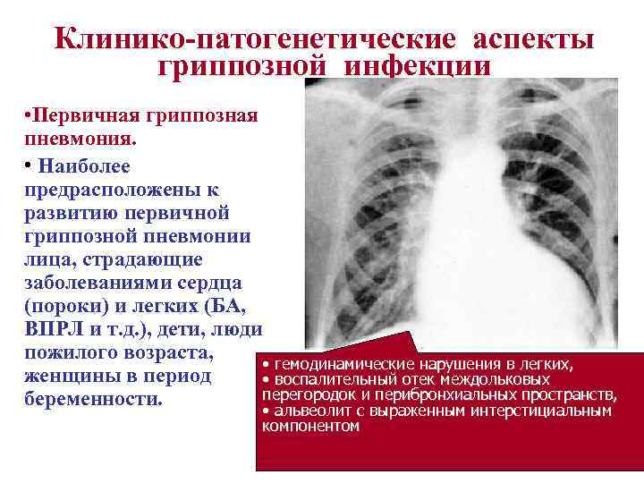 Клинико-патогенетические аспекты гриппозной инфекции • Первичная гриппозная пневмония. • Наиболее предрасположены к развитию первичной